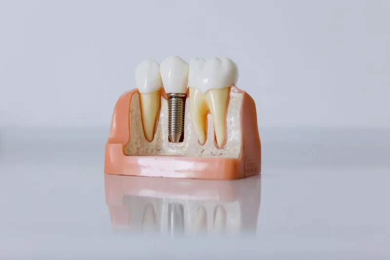 Illustrative teaching model showing how a dental implant screw sits in the jawbone beside a natural tooth